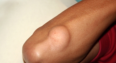 “Ağrı yoksa basit bir yağ bezesidir” demeyin!